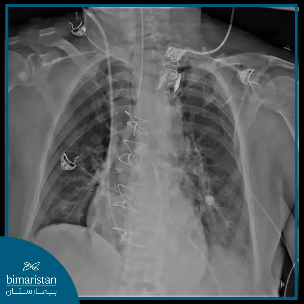 X-Ray Image Of Cardiac Catheterization