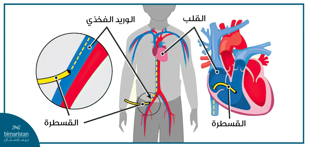 تموضع قسطرة القلب