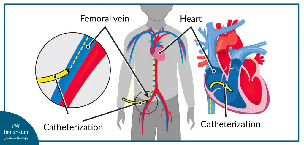 Cardiac Catheterization