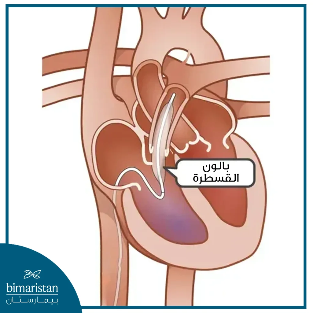 بالون القثطرة في قسطرة القلب الذي يستخدم لتوسيع التضيقات التي يمكن ان تشاهد أثناء القثطرة