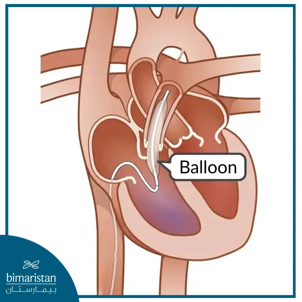 Balloon Catheter In Cardiac Catheterization That Is Used To Dilate Narrowings That May Be Seen During Catheterization.