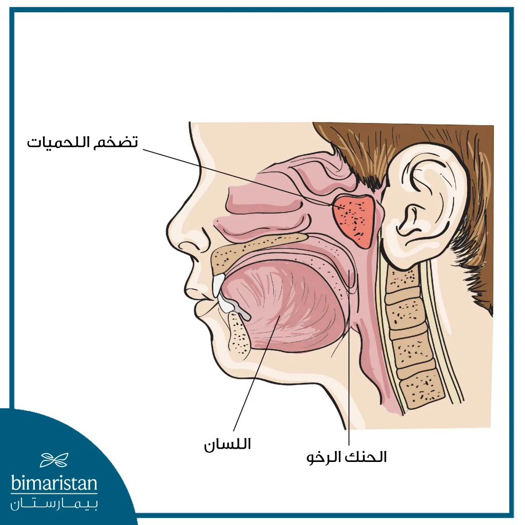 صورة توضح موقع لحمية الأنف وتضخم لحمية الأنف