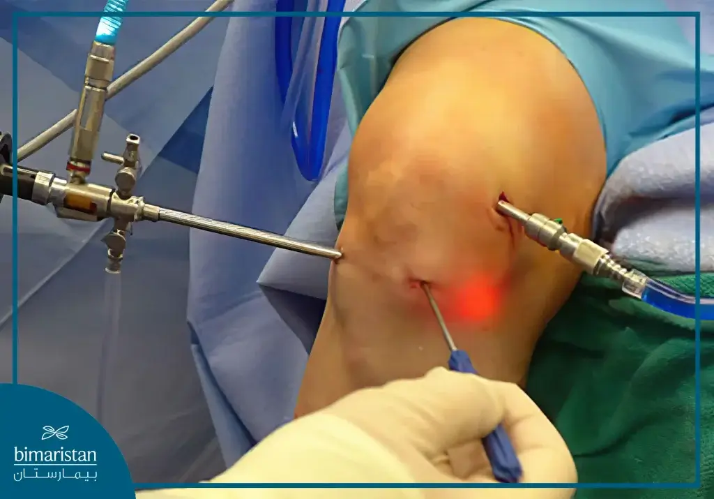 Knee Arthroscopy