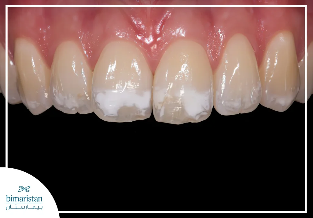 Excessive Intake Of Fluoride And Its Incorrect Use May Cause White Discolorations Called Dental Fluorosis.