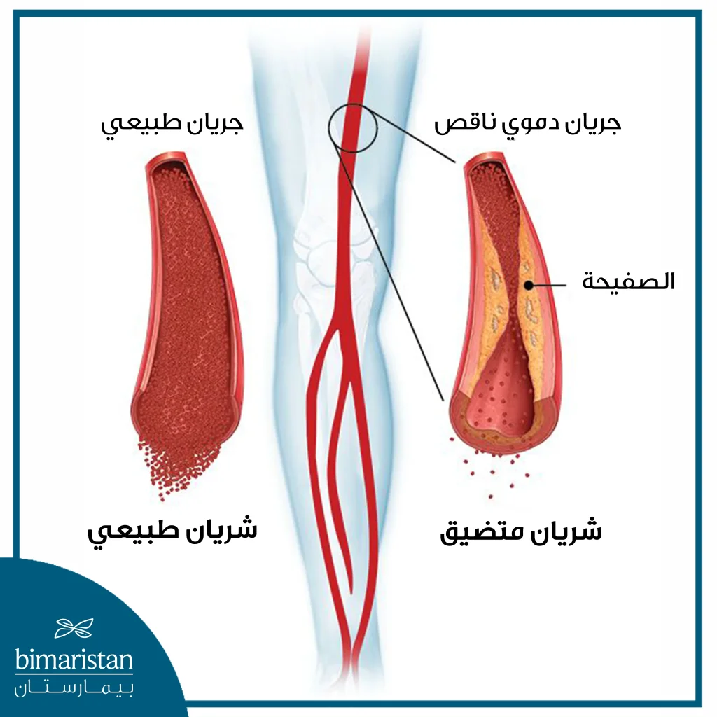 عندما تتشكل الصفيحة العصيدية بسبب تراكم الدهون يتضيق الشريان وتقل كفاءته في نقل كريات الدم الحمراء المحملة بالأوكسجين