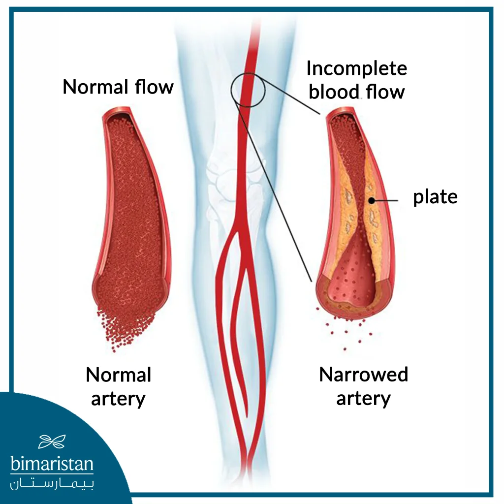 When Atherosclerosis Forms Due To The Accumulation Of Fat, The Artery Narrows And Its Efficiency In Transporting Oxygen-Laden Red Blood Cells Decreases.