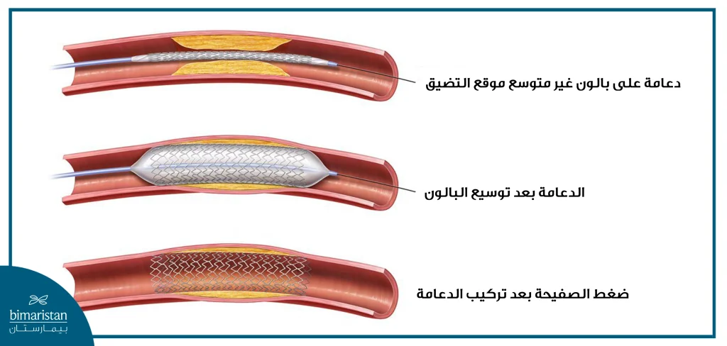 يتم إجراء قسطرة الشرايين الطرفية عن طريق إيصال الدعامة إلى الشريان المتضيق بواسطة القسطرة ثم يتم توسيعه بالبالون ثم تثبيته بالدعامة