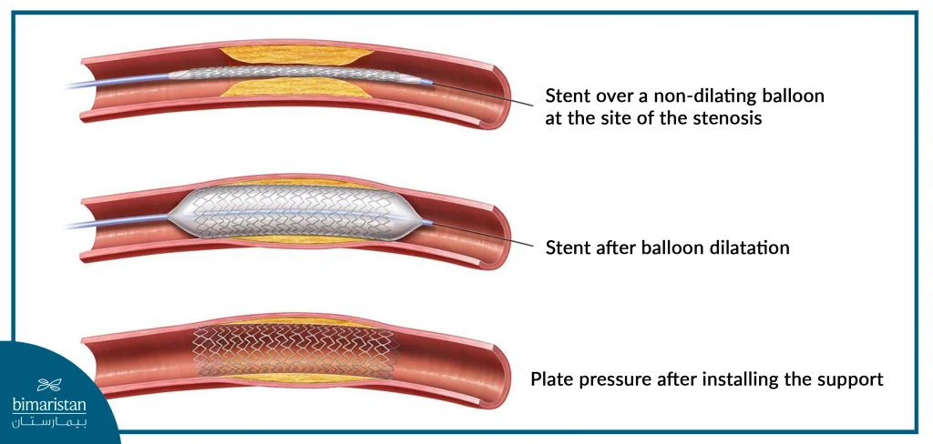 Peripheral Vascular Angioplasty Is Performed By Delivering A Stent To The Narrowed Artery Via A Catheter, Then Expanding It With A Balloon And Then Fixing It With A Stent.