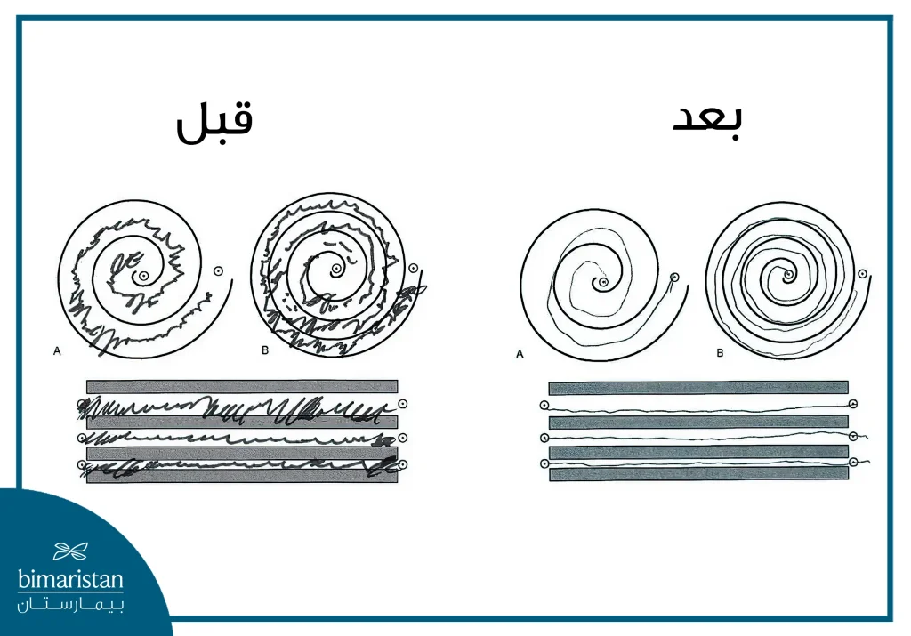 نتائج علاج الرعاش باستخدام تقنية Mrgfus