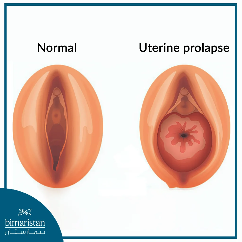 Uterine Prolapse Images