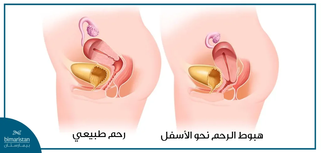 هبوط الرحم شكل المهبل للمتزوجه