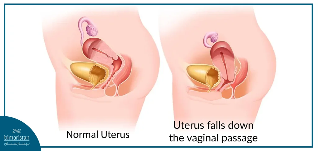 Uterine Prolapse, Shape Of The Vagina For Married Women