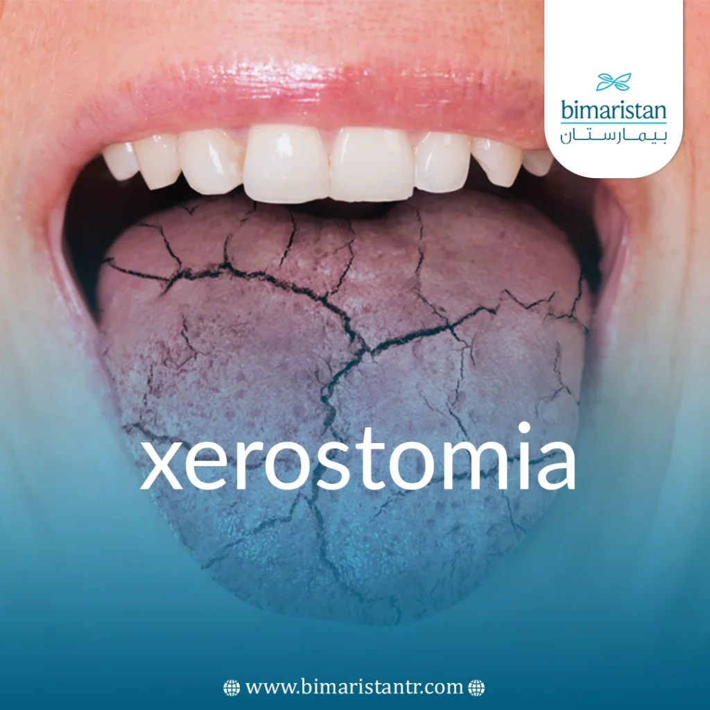 Xerostomia Causes And Treatment