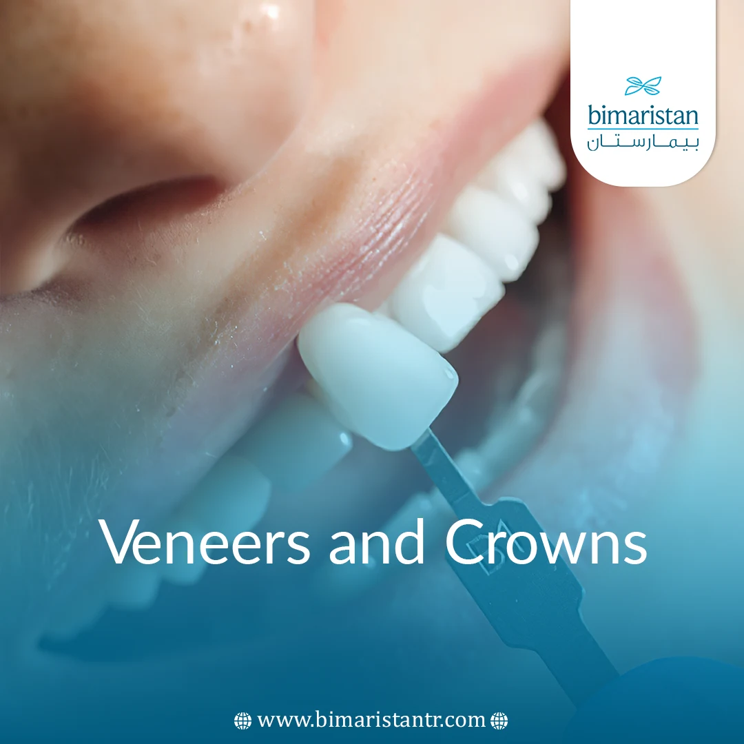 Dental Veneers And Crowns Types