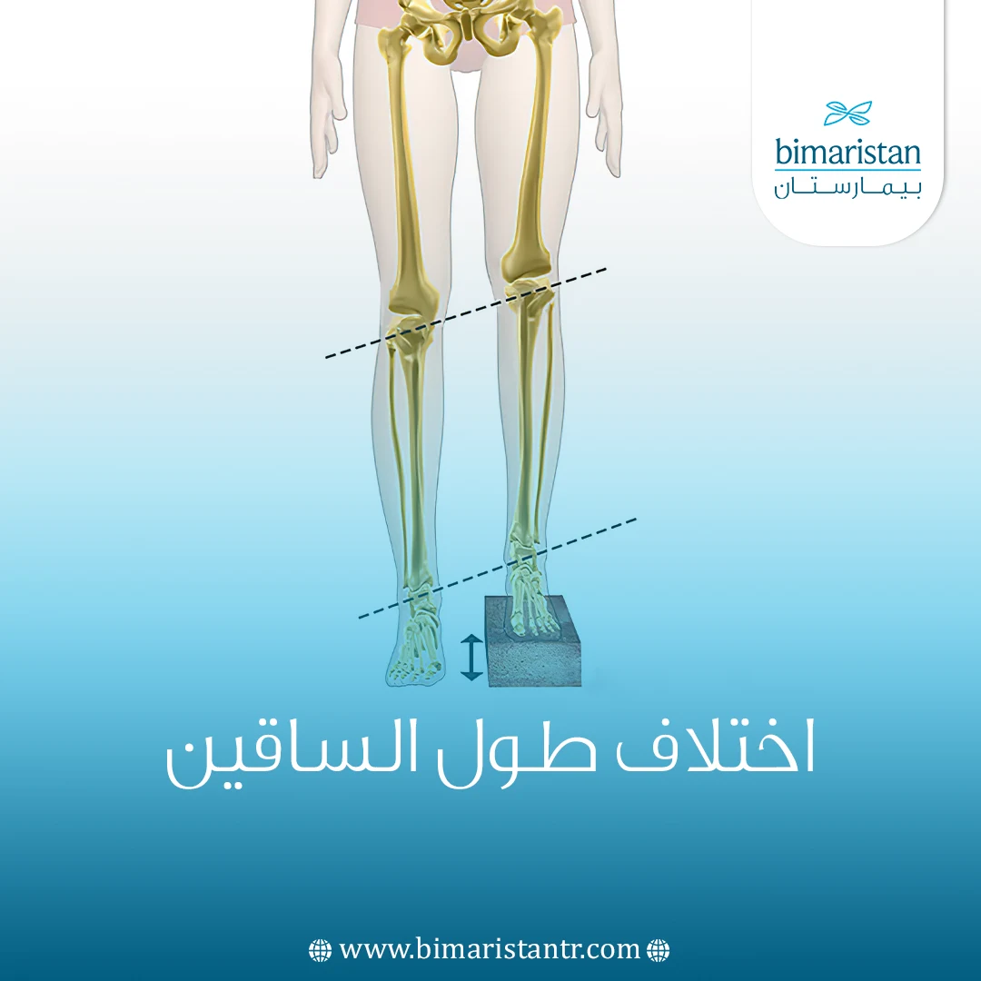 أعراض اختلاف طول الساقين وطريقة العلاج في تركيا