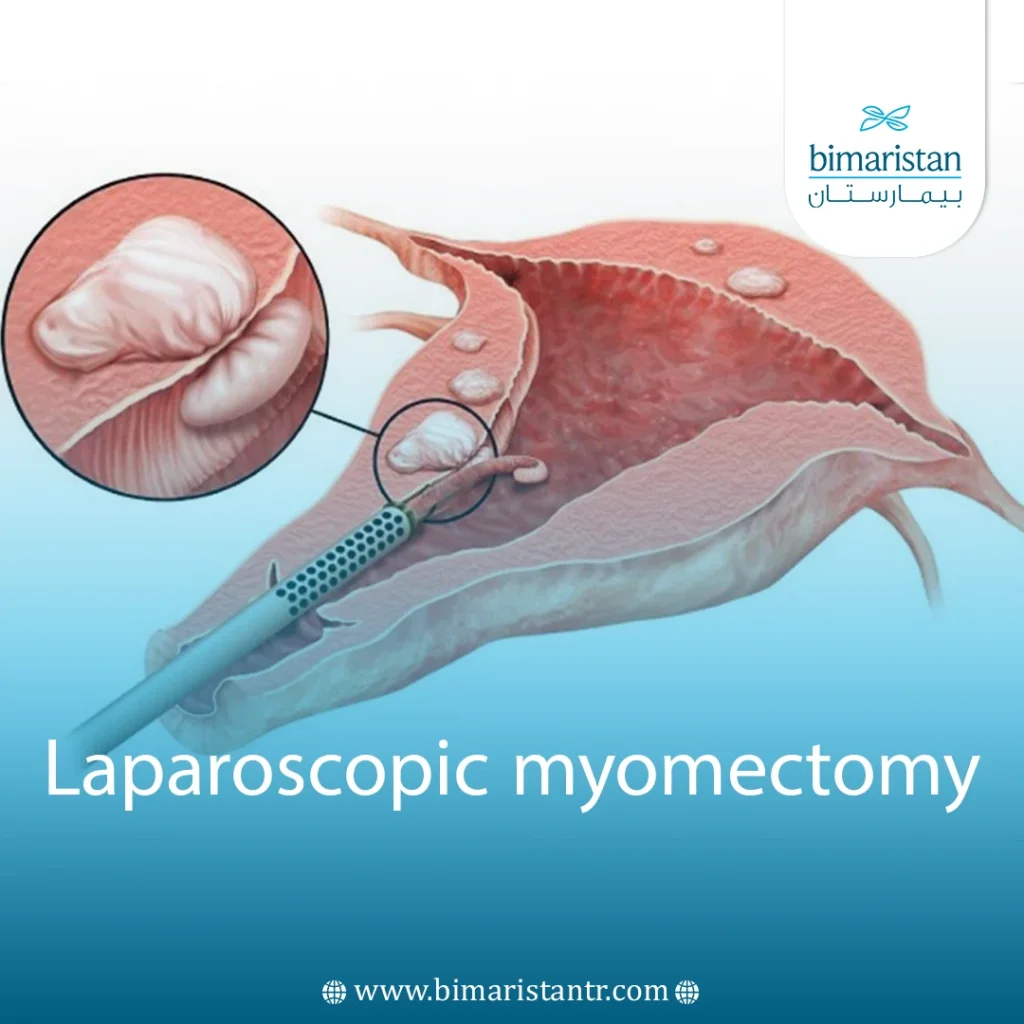 Laparoscopic Myomectomy