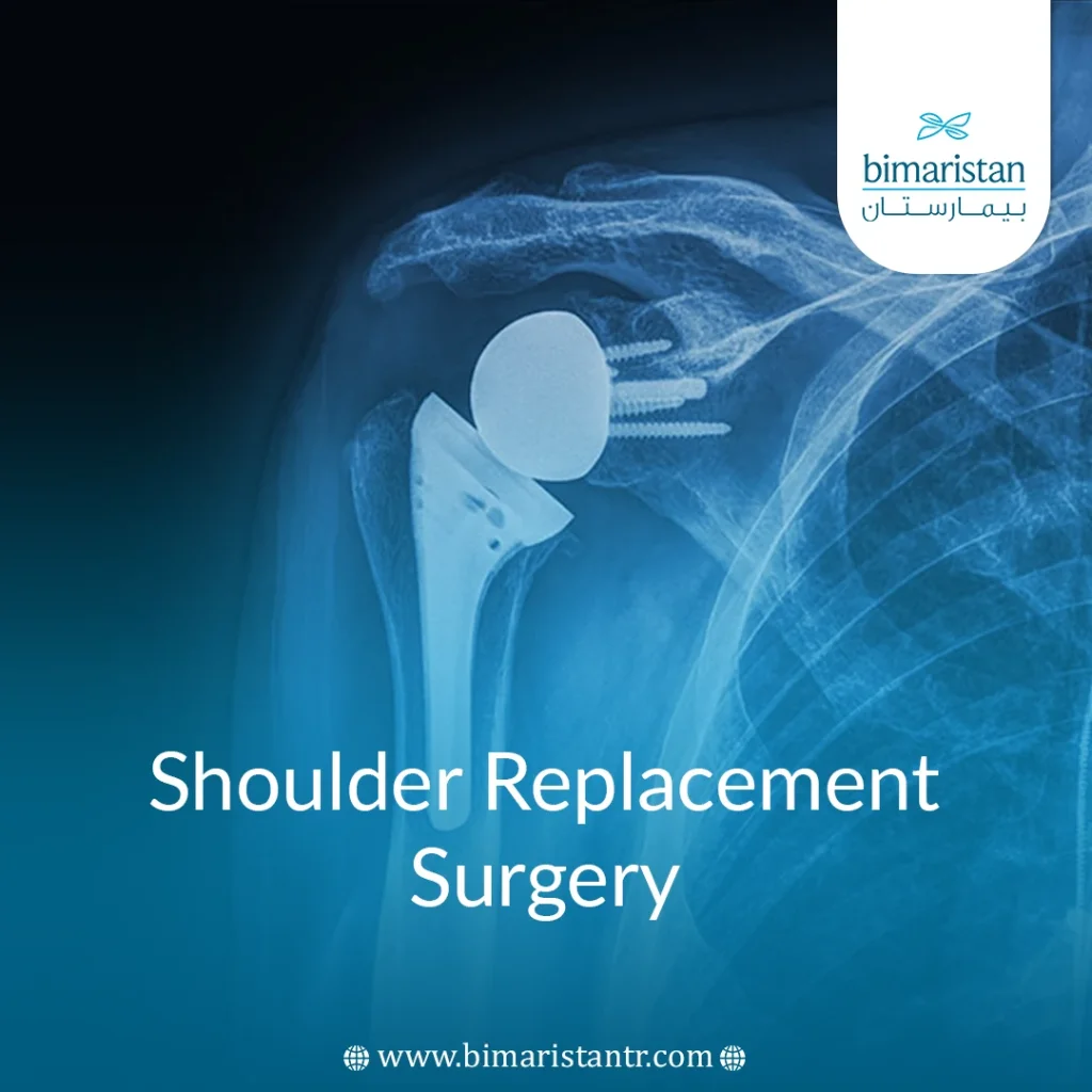 Shoulder replacement surgery