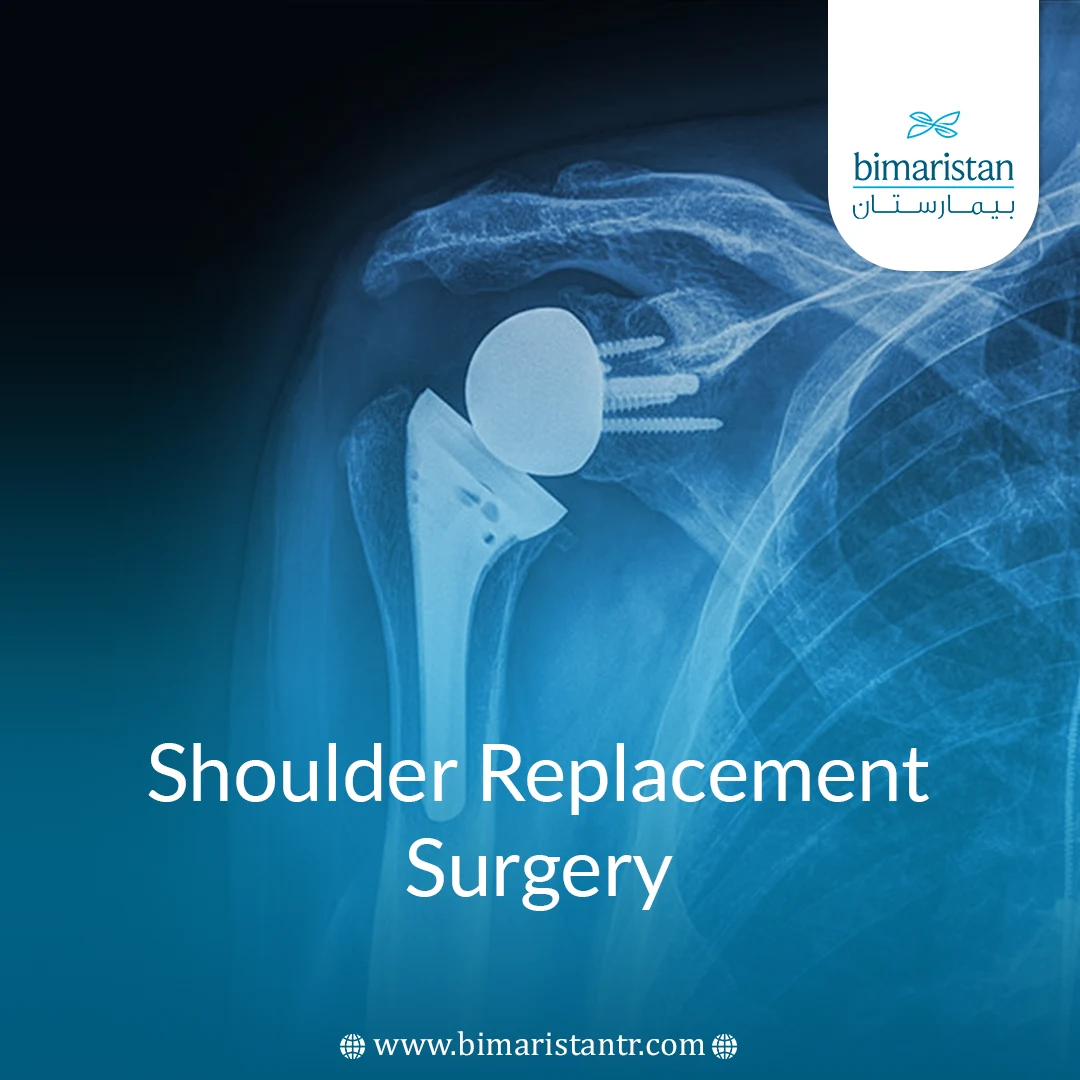 Shoulder Replacement Surgery