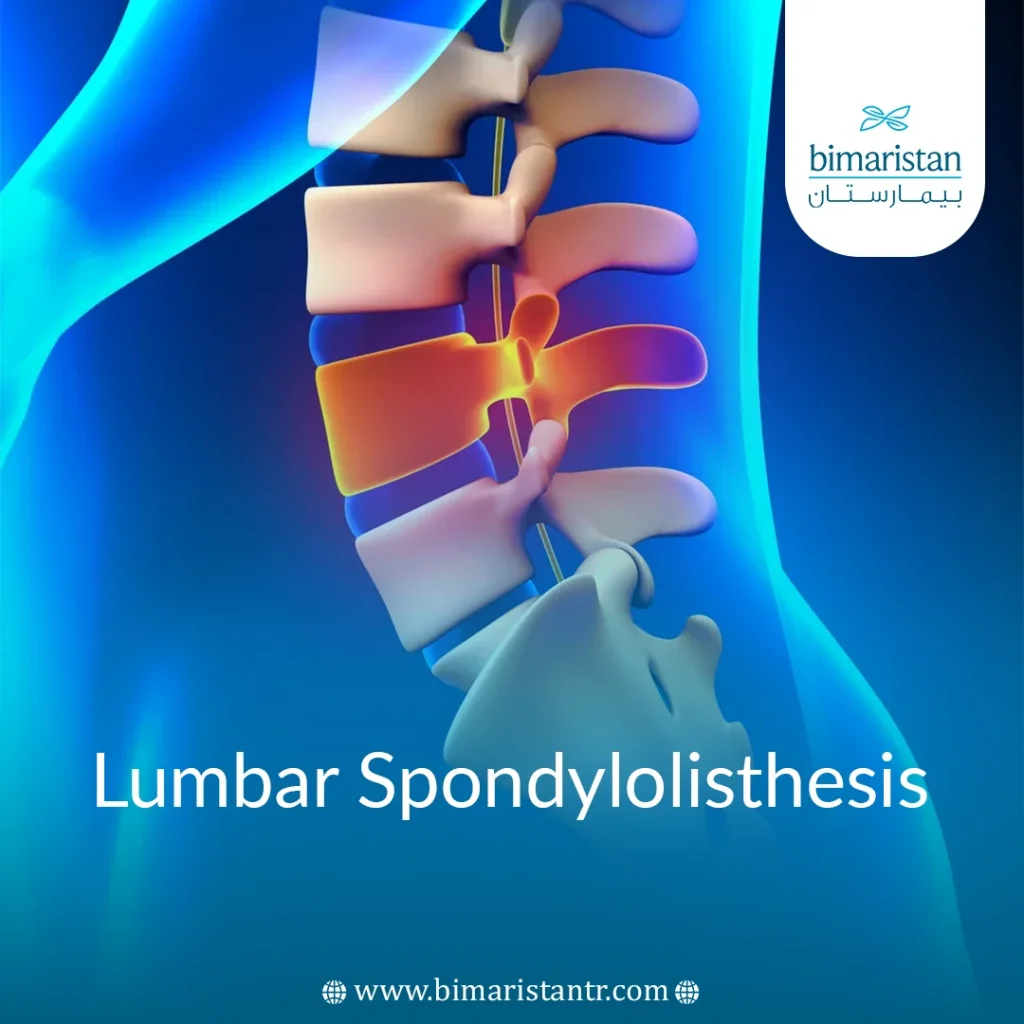 Lumbar Spondylolisthesis