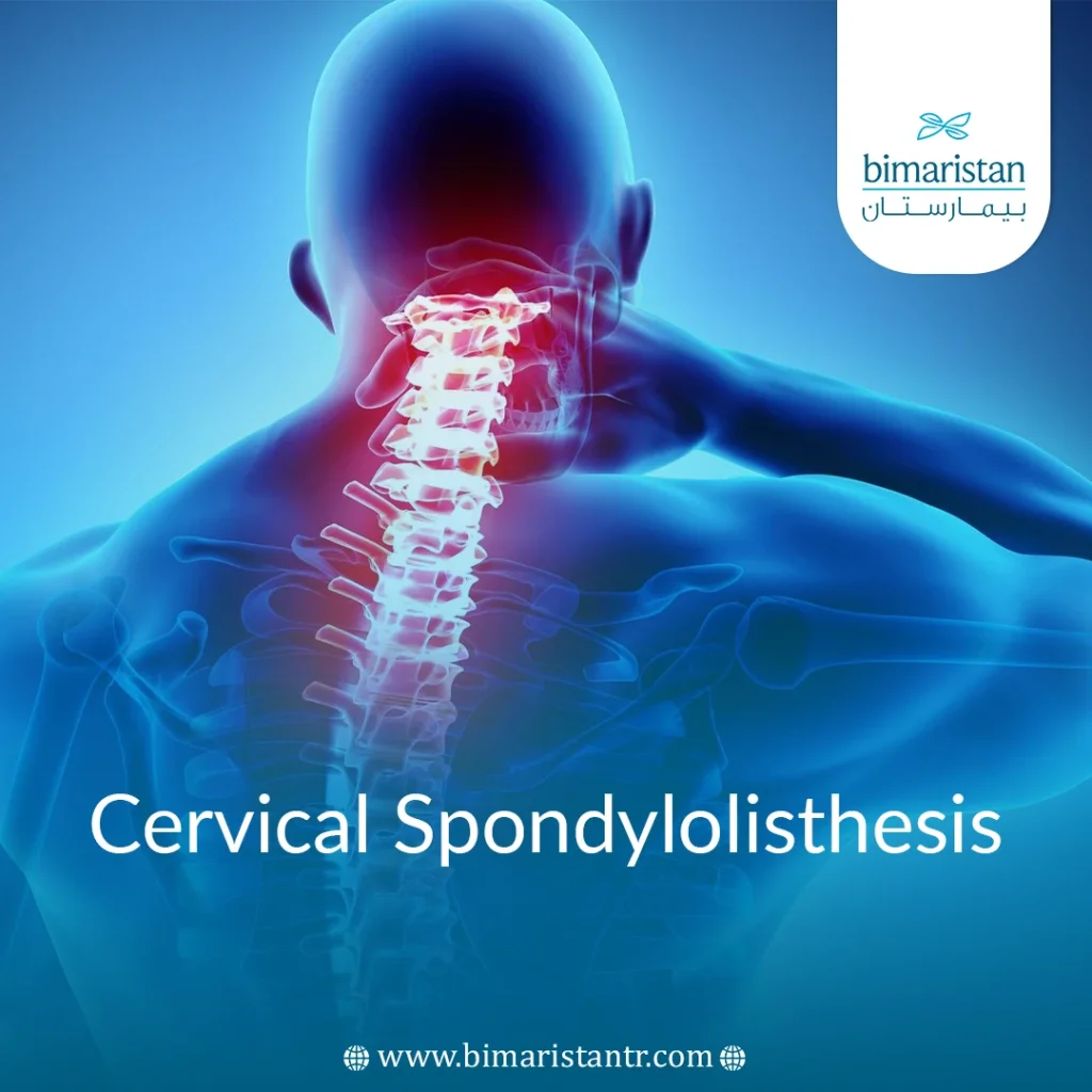 Cervical Spondylolisthesis