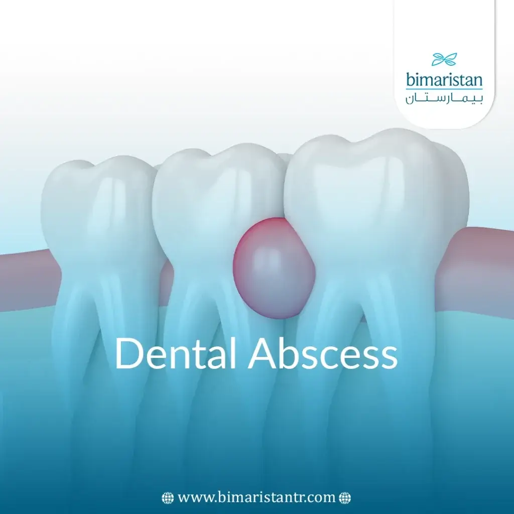 Dental Abscess