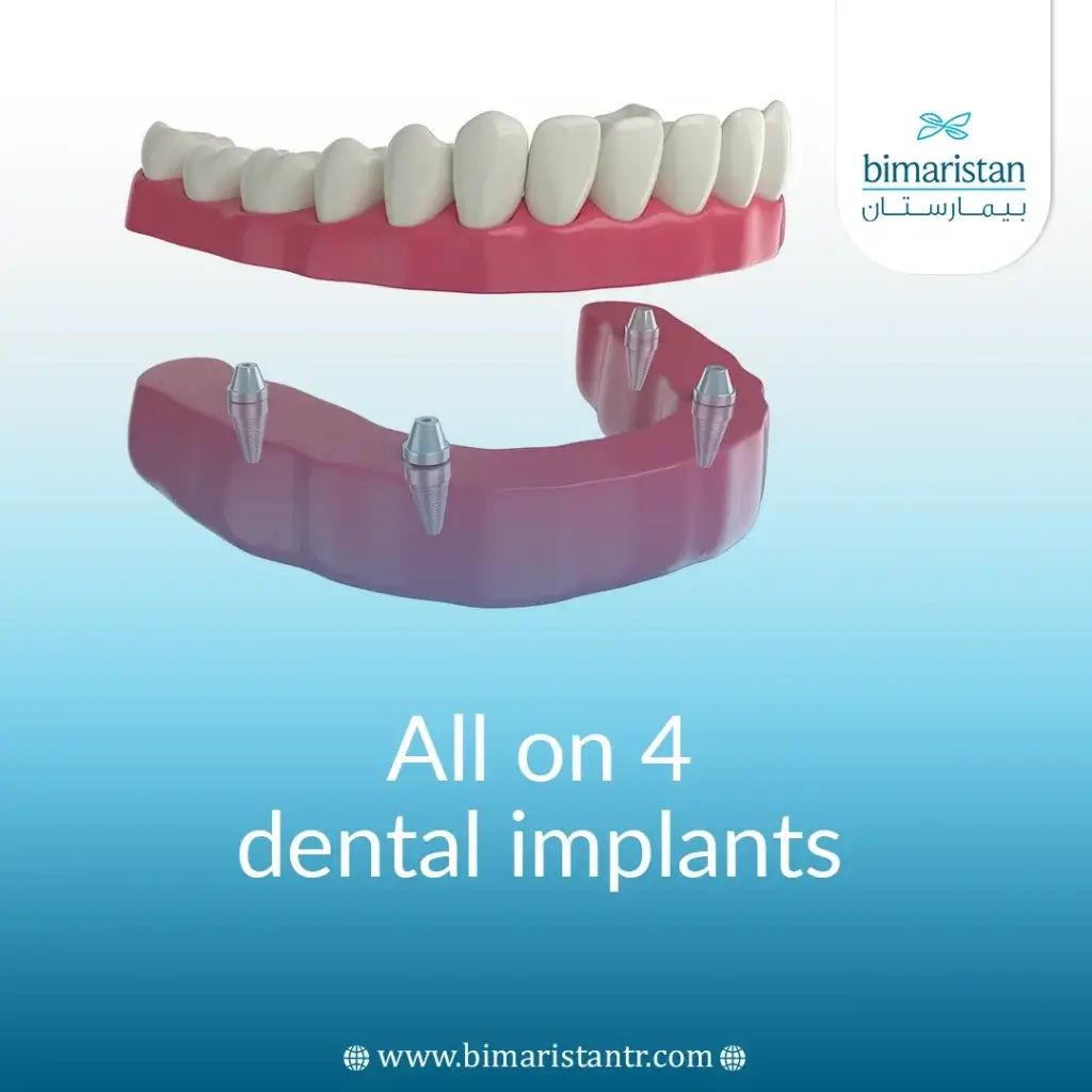 All-On-Four Dental Implants In Istanbul