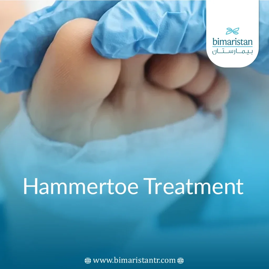 Hammertoe Treatment