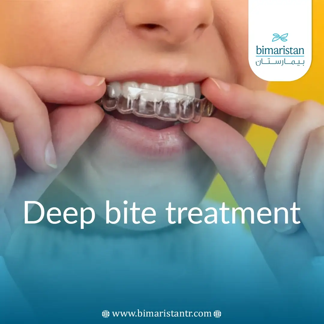 Deep Bite Treatment With Clear Aligners