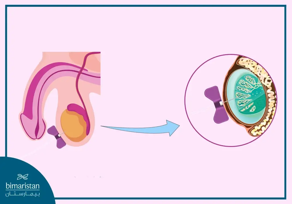 Testicular Biopsy To Determine The Sperm Abnormalities Causes