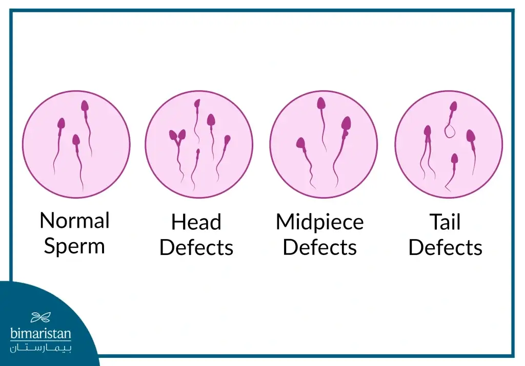 Types Of Sperm Abnormalities