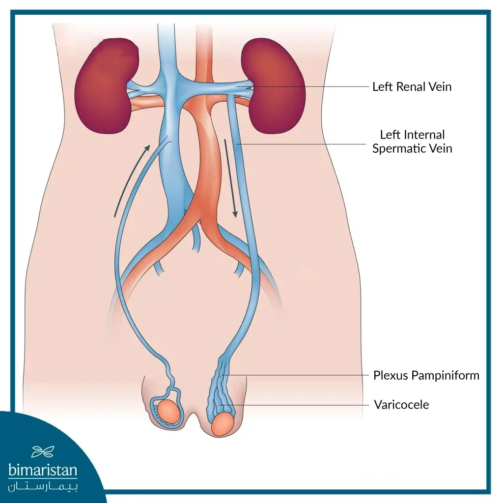 Anatomical Variation In The Left Testicular Vein, Which Is One Of The Varicocele Causes, As The Left Testicular Vein Drains Into The Renal Vein At A Right Angle, Which Increases The Possibility Of Blood Flow Problems.