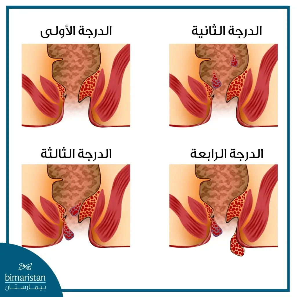 درجات البواسير الشرجية