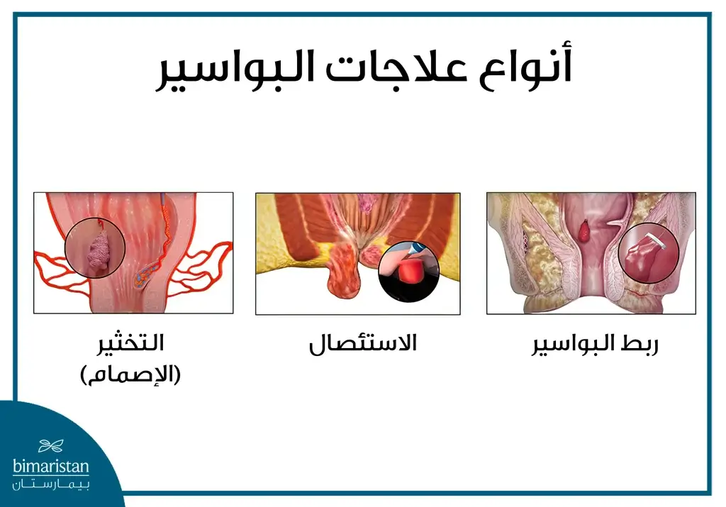 مقارنة بين علاج البواسير بالتخثير والعلاجات الأخرى