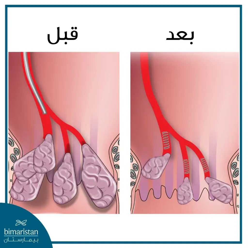 علاج البواسير بالتخثير قبل وبعد