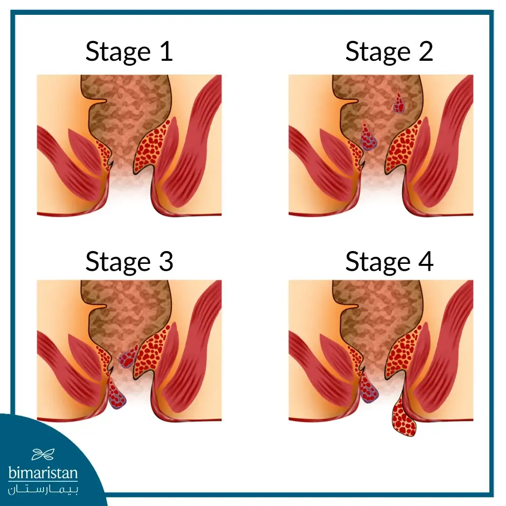 Degrees of anal hemorrhoids