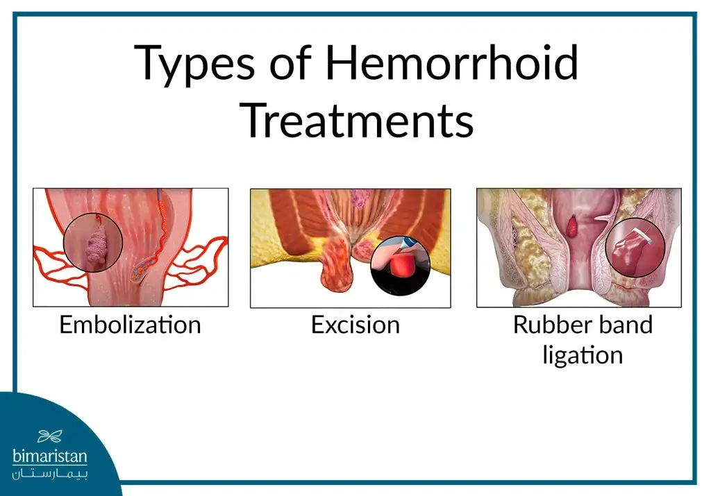 Comparison of Hemorrhoid Embolization with Other Treatments