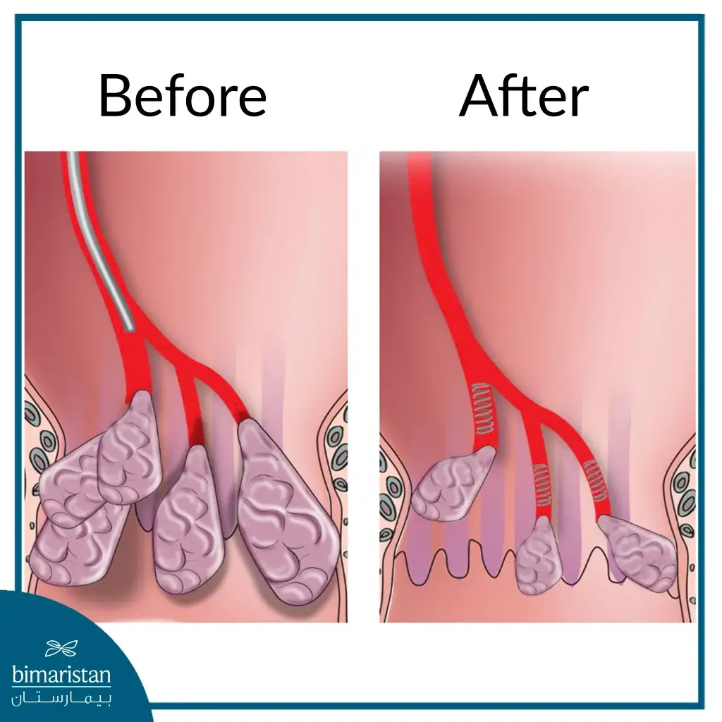 Hemorrhoid Embolization Treatment Before And After