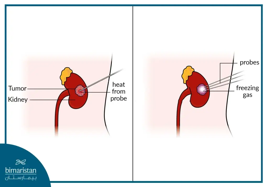 Freezing and heating probes used in thermal ablation