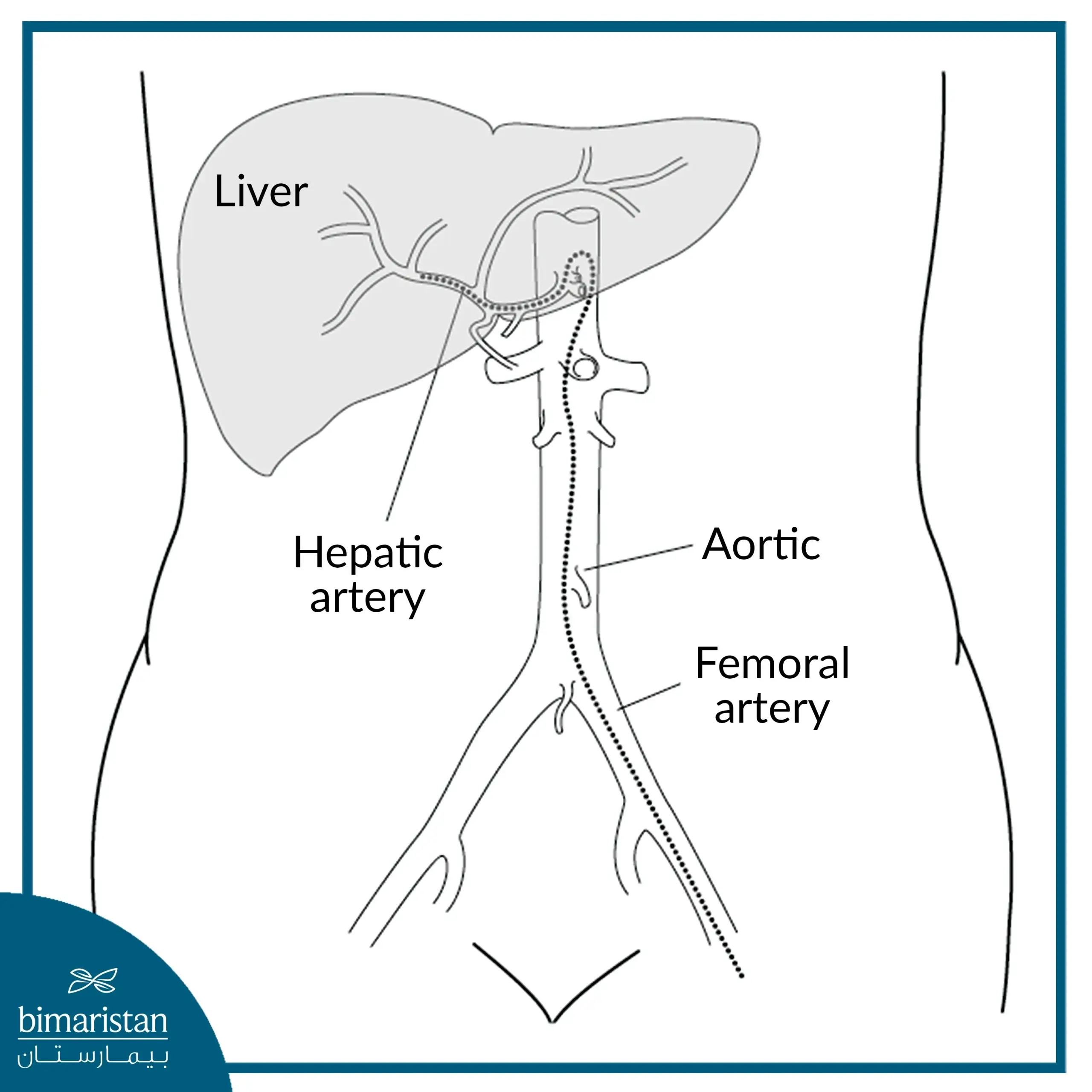 Tumor embolization in liver