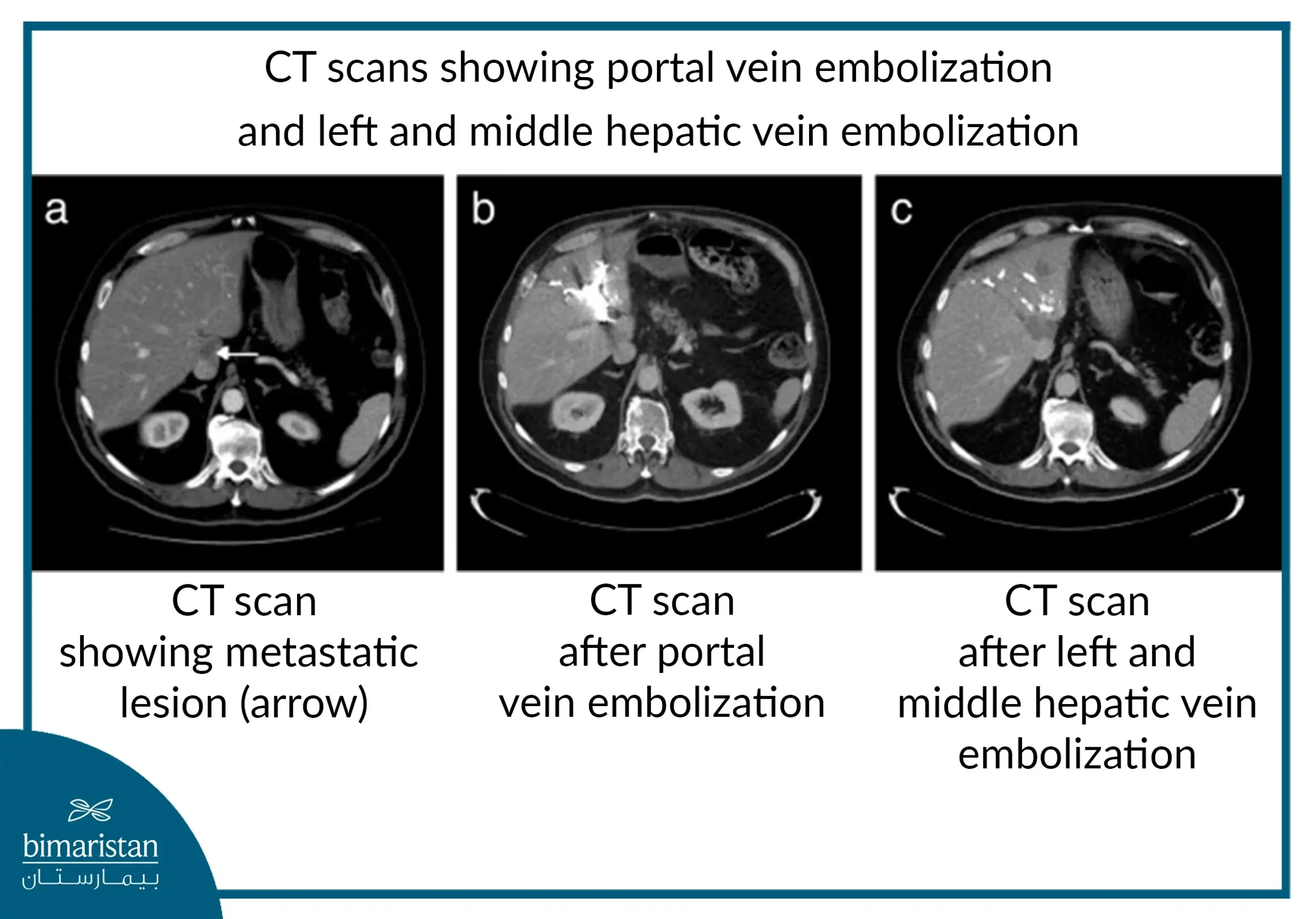 CT scans showing portal vein embolization and left and middle hepatic vein embolization