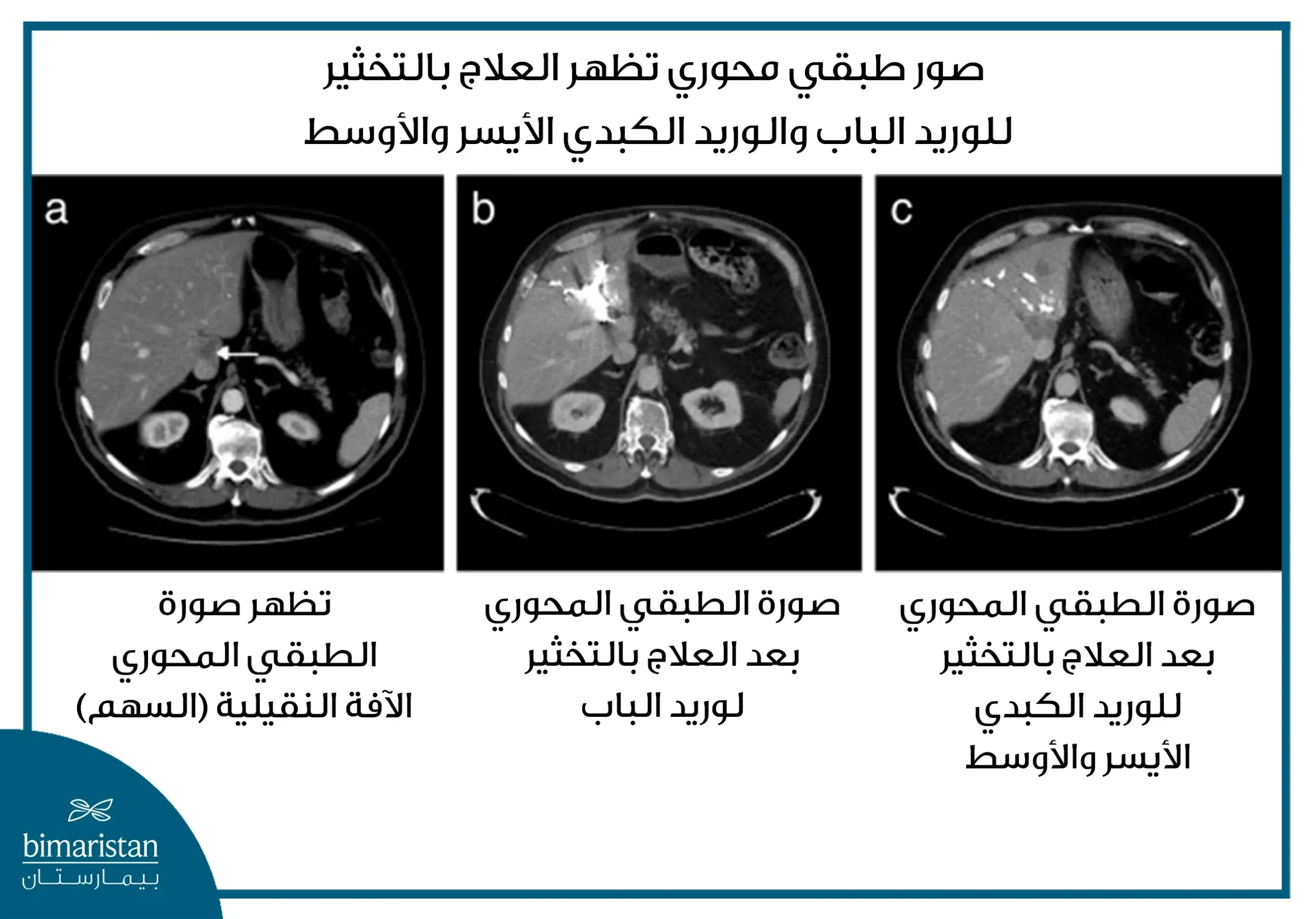 صور طبقي محوري تظهر العلاج بالتخثير للوريد الباب والوريد الكبدي الأيسر والأوسط