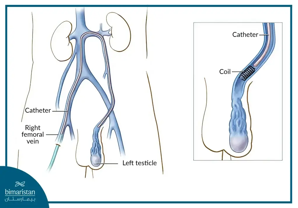 Catheter Insertion In Varicocele Embolization