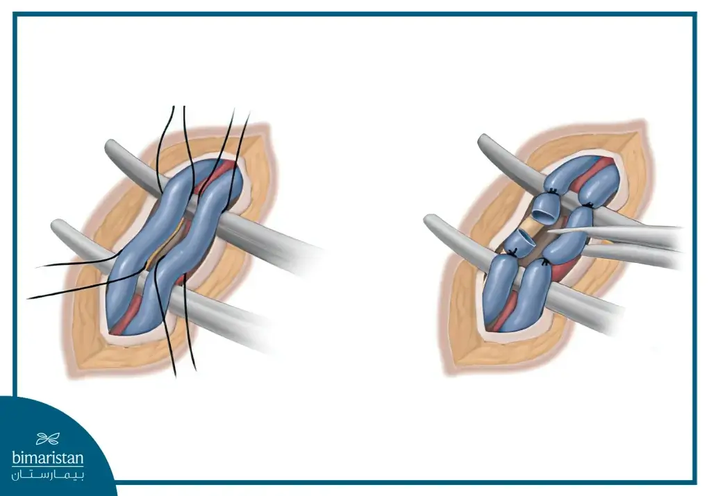 Surgical Approach For The Treatment Of Varicocele