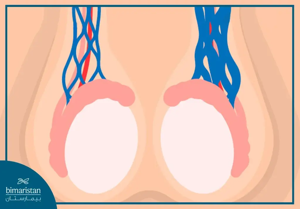 Image Showing The Normal Spermatic Veins (Left) And The Spermatic Veins Affected By Varicocele (Right)