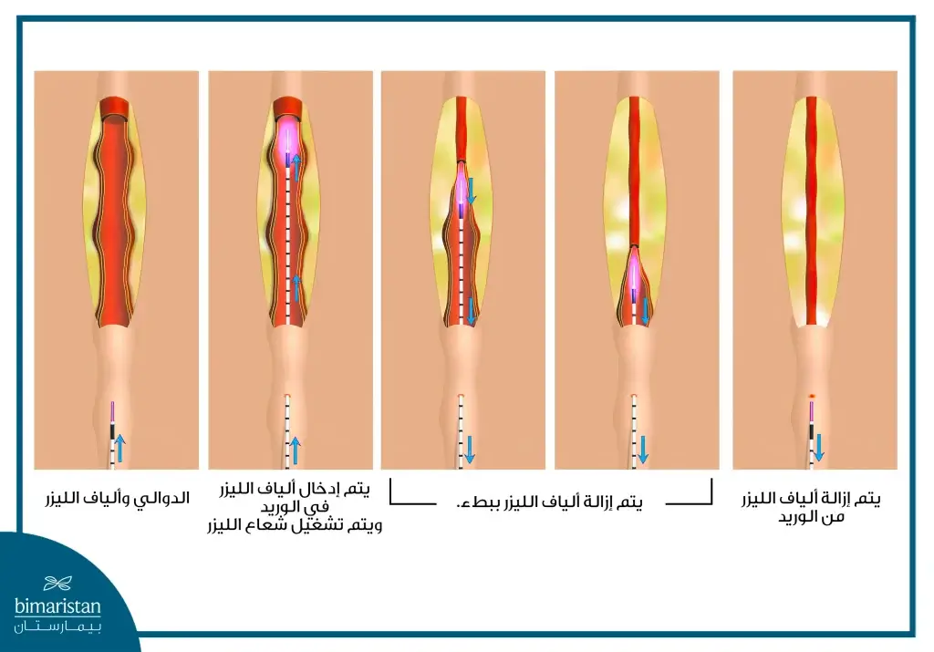 علاج دوالي الساقين بالتخثير الليزري