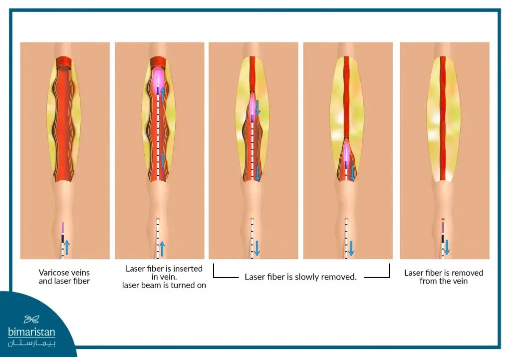 Varicose vein embolization with laser