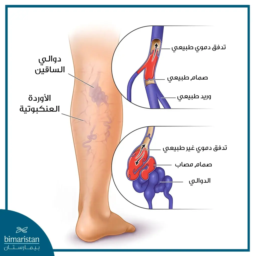 دوالي الساقين بالصور