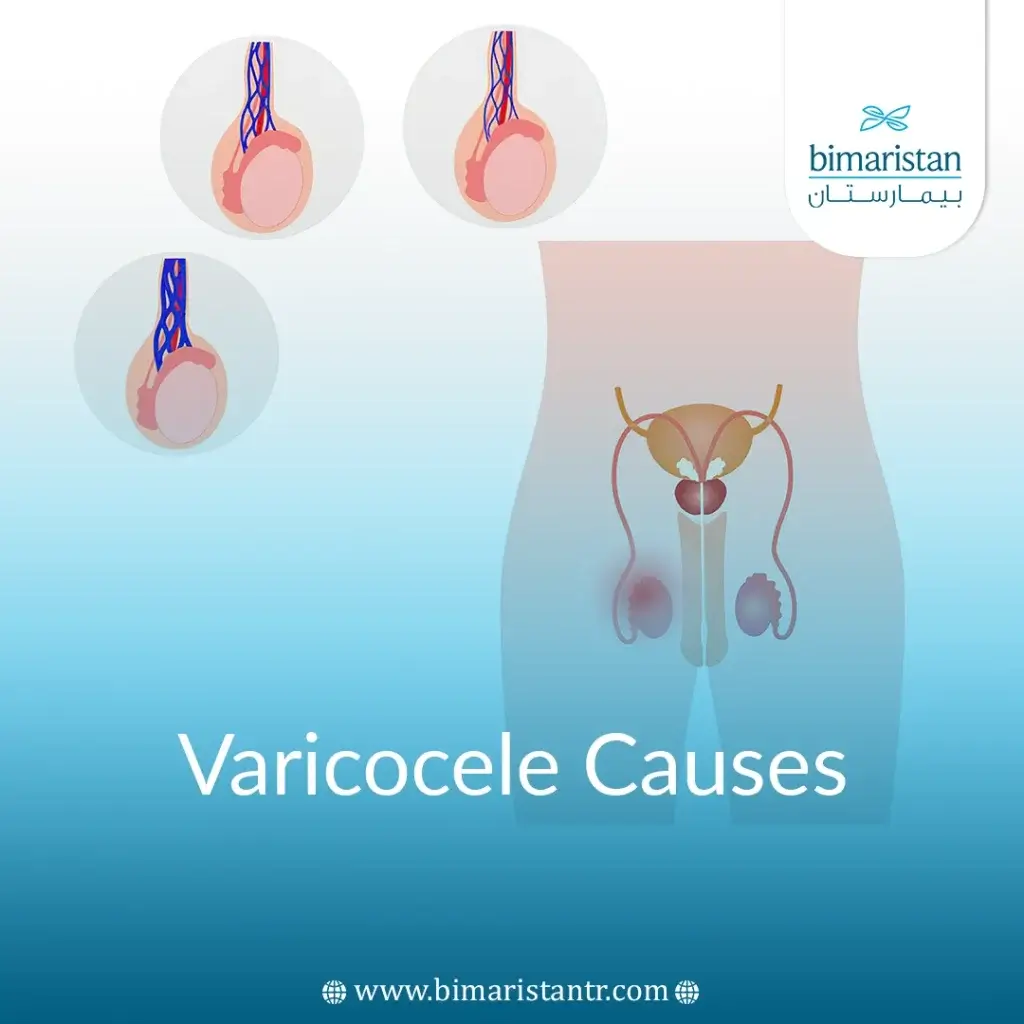 Varicocele Causes