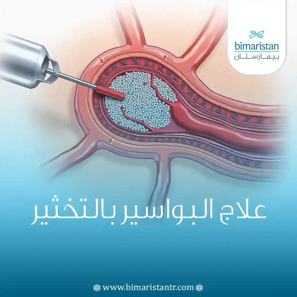 علاج البواسير بالتخثير