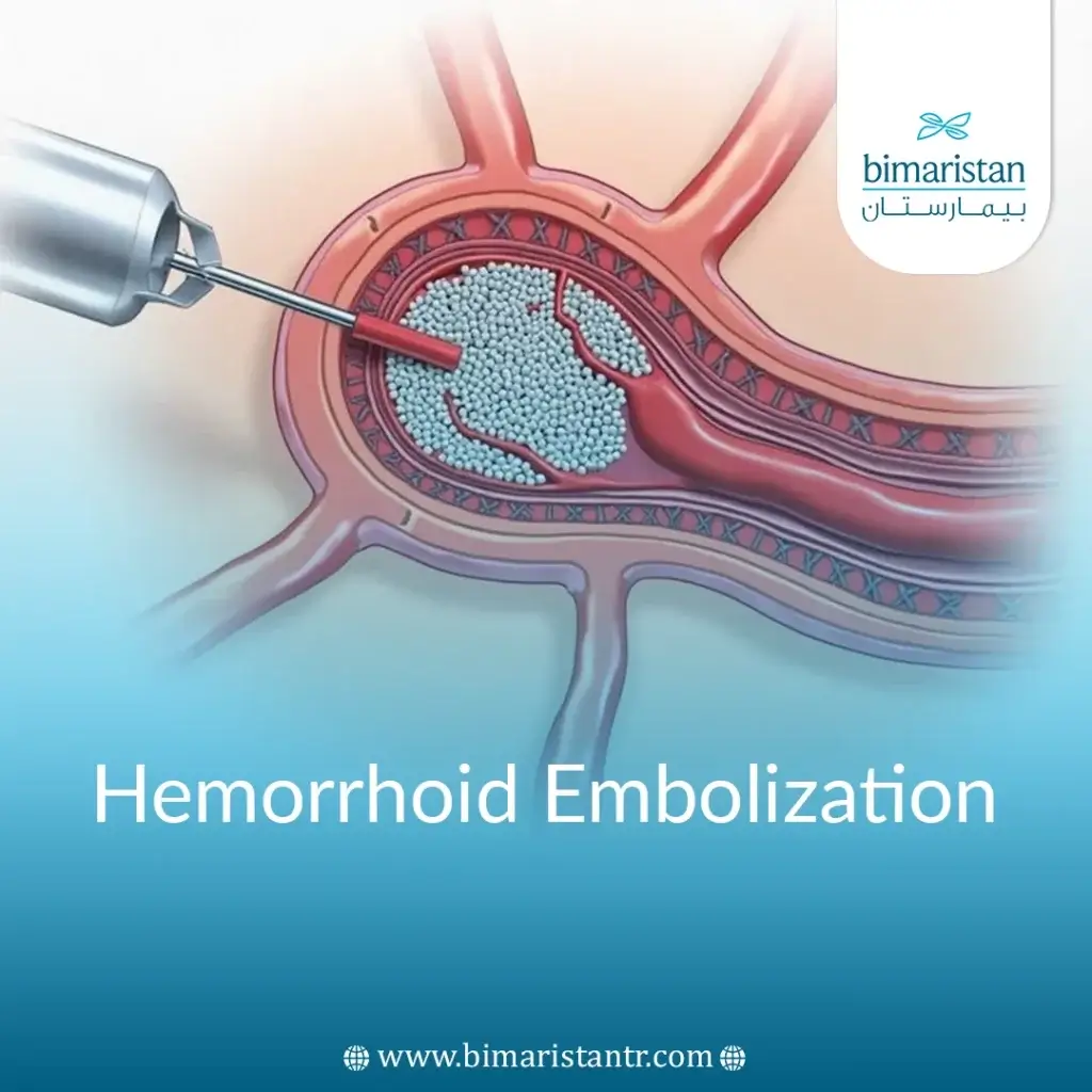 Hemorrhoid Embolization